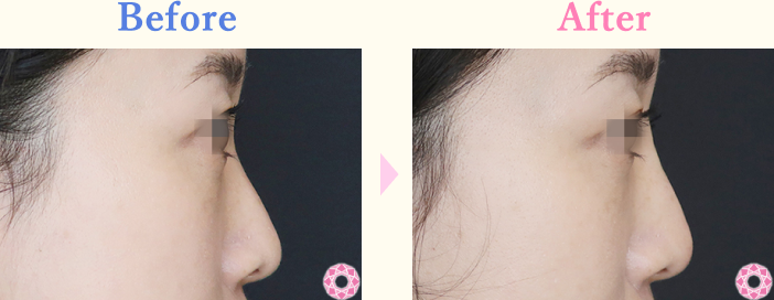 年代：30代 施術名：プチ隆鼻術（ヒアルロン酸） 施術前後｜【公式】東京形成美容外科