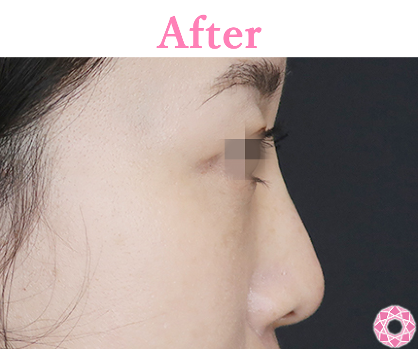 年代：30代 施術名：プチ隆鼻術（ヒアルロン酸） 施術後 拡大画像｜【公式】東京形成美容外科