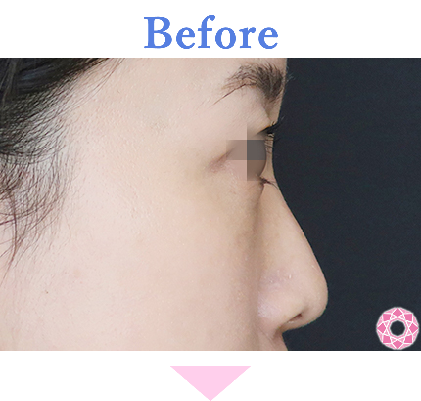 年代：30代 施術名：プチ隆鼻術（ヒアルロン酸） 施術前 拡大画像｜【公式】東京形成美容外科