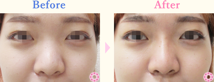 年代：20代 施術名：プチ隆鼻術（ヒアルロン酸） 施術前後｜【公式】東京形成美容外科