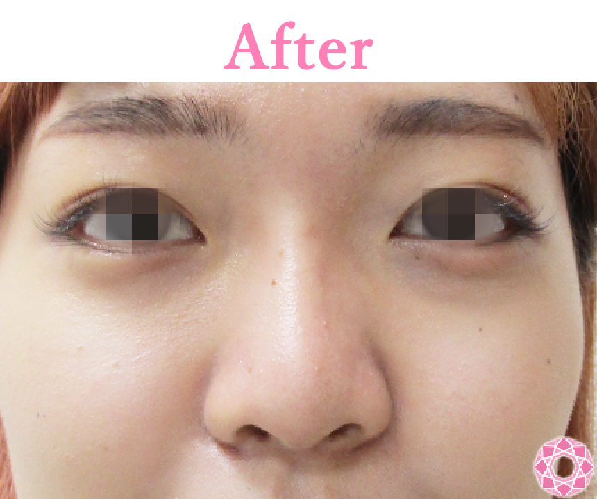 年代：20代 施術名：プチ隆鼻術（ヒアルロン酸） 施術後 拡大画像｜【公式】東京形成美容外科