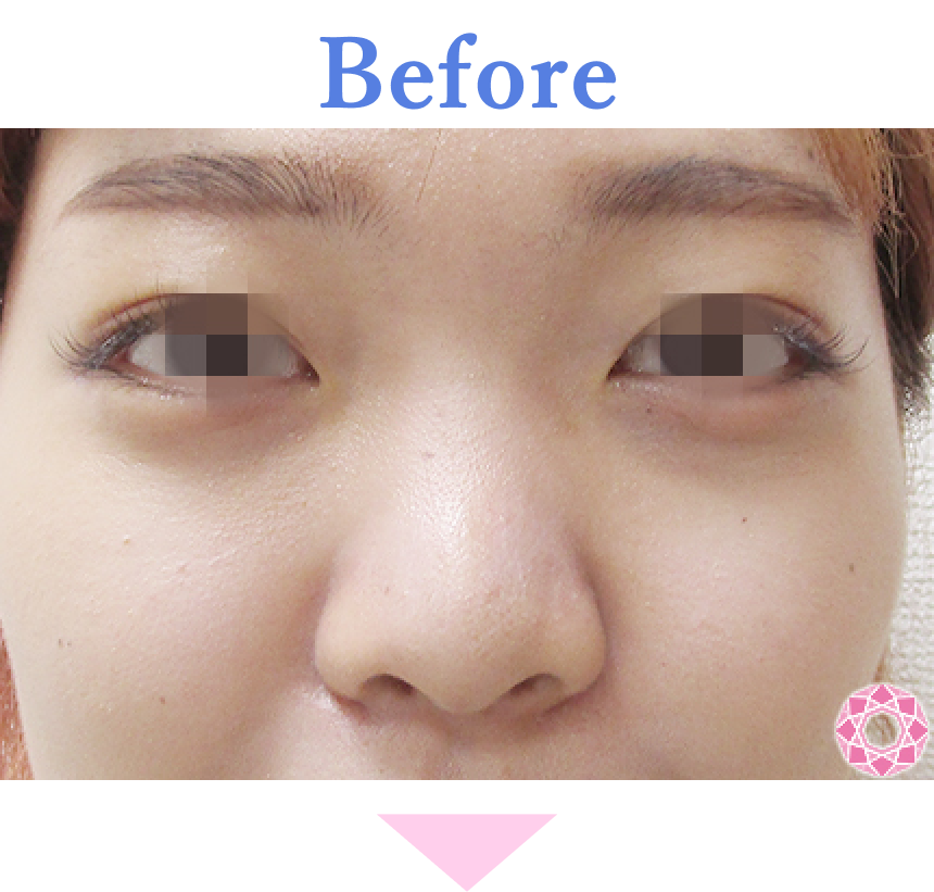 年代：20代 施術名：プチ隆鼻術（ヒアルロン酸） 施術前 拡大画像｜【公式】東京形成美容外科