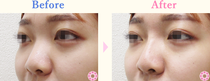 年代：20代 施術名：プチ隆鼻術（ヒアルロン酸） 施術前後｜【公式】東京形成美容外科