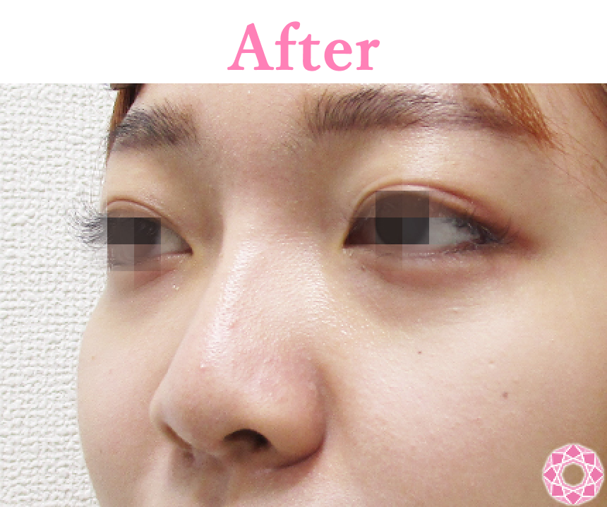 年代：20代 施術名：プチ隆鼻術（ヒアルロン酸） 施術後 拡大画像｜【公式】東京形成美容外科