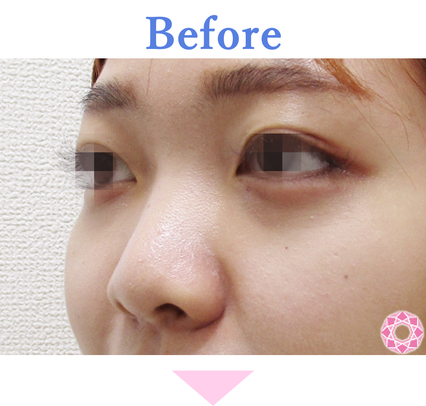 年代：20代 施術名：プチ隆鼻術（ヒアルロン酸） 施術前 拡大画像｜【公式】東京形成美容外科