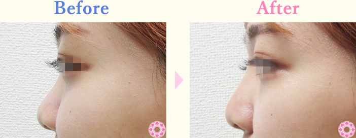 年代：20代 施術名：プチ隆鼻術（ヒアルロン酸） 施術前後｜【公式】東京形成美容外科