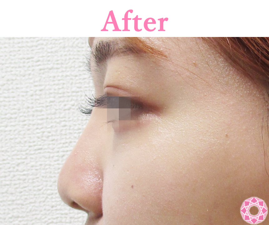 年代：20代 施術名：プチ隆鼻術（ヒアルロン酸） 施術後 拡大画像｜【公式】東京形成美容外科