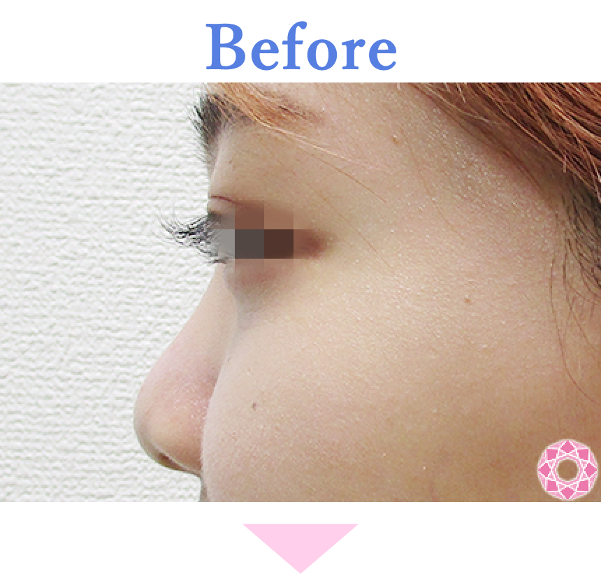 年代：20代 施術名：プチ隆鼻術（ヒアルロン酸） 施術前 拡大画像｜【公式】東京形成美容外科