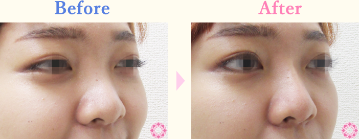 年代：20代 施術名：プチ隆鼻術（ヒアルロン酸） 施術前後｜【公式】東京形成美容外科