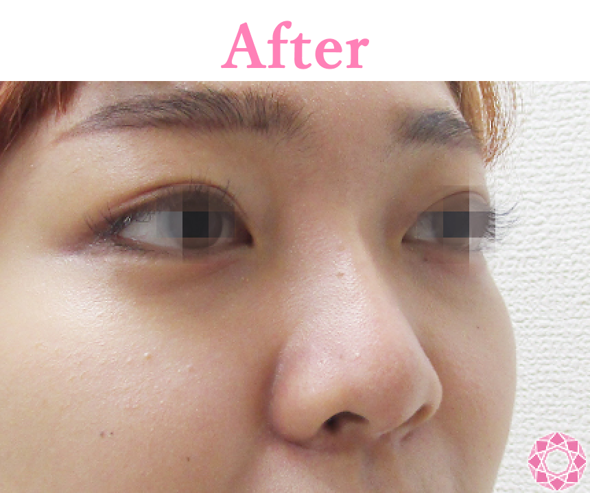 年代：20代 施術名：プチ隆鼻術（ヒアルロン酸） 施術後 拡大画像｜【公式】東京形成美容外科