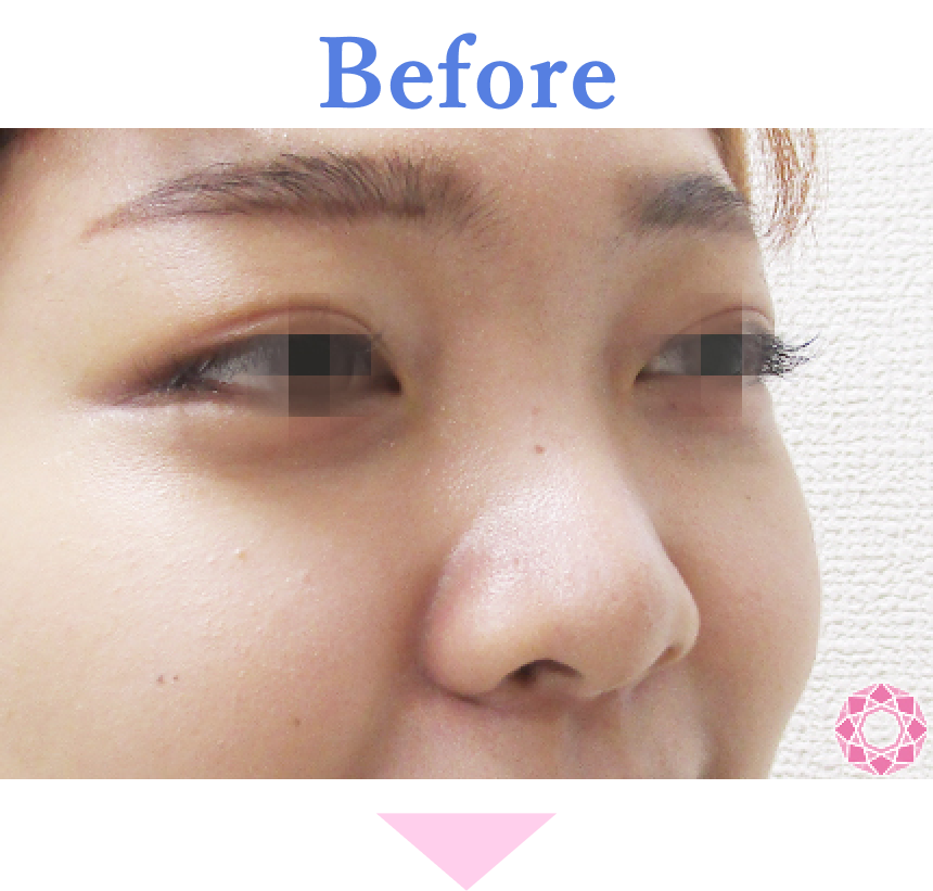 年代：20代 施術名：プチ隆鼻術（ヒアルロン酸） 施術前 拡大画像｜【公式】東京形成美容外科