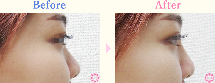 年代：20代 施術名：プチ隆鼻術（ヒアルロン酸） 施術前後｜【公式】東京形成美容外科