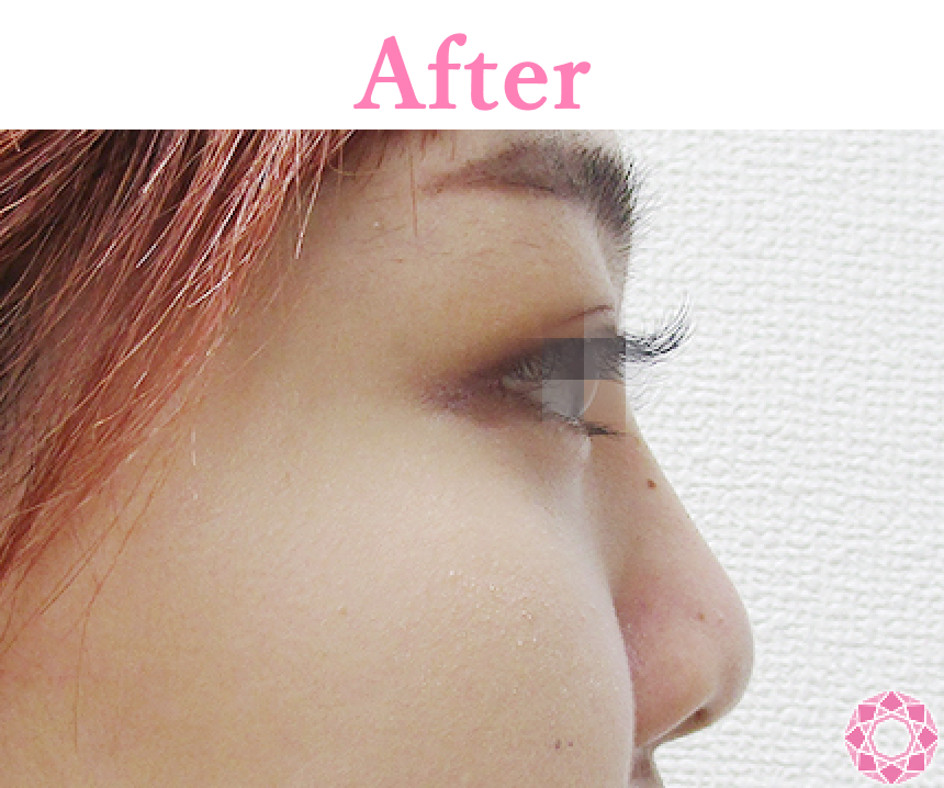 年代：20代 施術名：プチ隆鼻術（ヒアルロン酸） 施術後 拡大画像｜【公式】東京形成美容外科