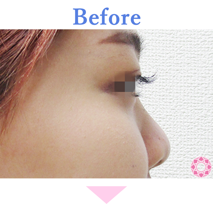 年代：20代 施術名：プチ隆鼻術（ヒアルロン酸） 施術前 拡大画像｜【公式】東京形成美容外科