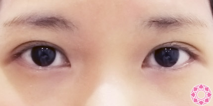 年代：20代 施術名：二重埋没法 施術後｜【公式】東京形成美容外科