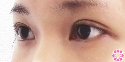 年代：20代 施術名：二重埋没法 施術後｜【公式】東京形成美容外科