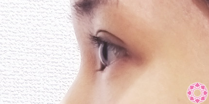 年代：20代 施術名：二重埋没法 施術後｜【公式】東京形成美容外科