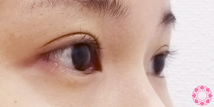 年代：20代 施術名：二重埋没法 施術後｜【公式】東京形成美容外科