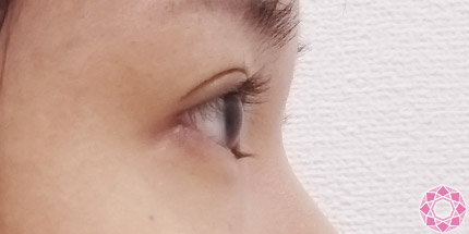 年代：20代 施術名：二重埋没法 施術後｜【公式】東京形成美容外科