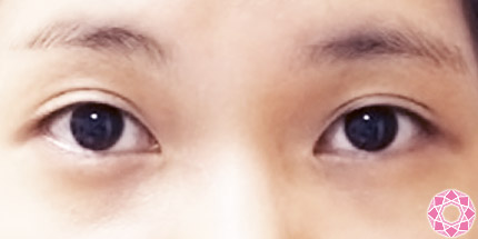 年代：20代 施術名：二重埋没法 施術前｜【公式】東京形成美容外科