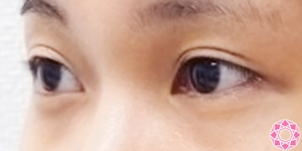年代：20代 施術名：二重埋没法 施術前｜【公式】東京形成美容外科