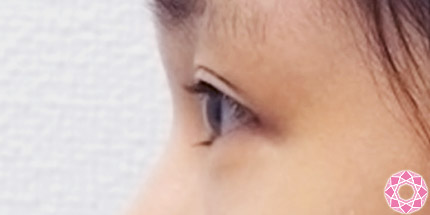 年代：20代 施術名：二重埋没法 施術前｜【公式】東京形成美容外科