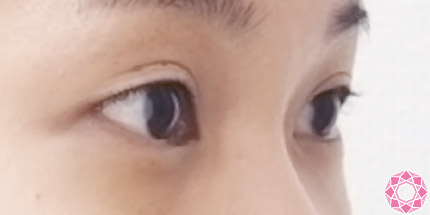 年代：20代 施術名：二重埋没法 施術前｜【公式】東京形成美容外科