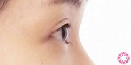 年代：20代 施術名：二重埋没法 施術前｜【公式】東京形成美容外科