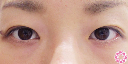 年代：30代 施術名：二重埋没法 施術後｜【公式】東京形成美容外科