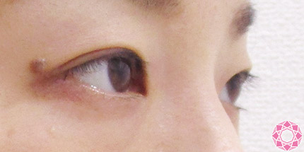 年代：30代 施術名：二重埋没法 施術後｜【公式】東京形成美容外科