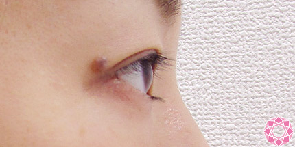 年代：30代 施術名：二重埋没法 施術後｜【公式】東京形成美容外科