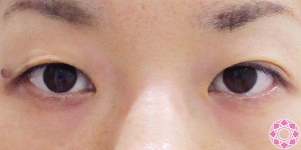 年代：30代 施術名：二重埋没法 施術前｜【公式】東京形成美容外科