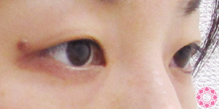 年代：30代 施術名：二重埋没法 施術前｜【公式】東京形成美容外科