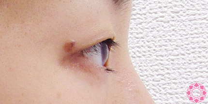 年代：30代 施術名：二重埋没法 施術前｜【公式】東京形成美容外科