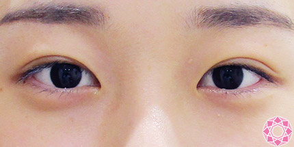 年代：10代 施術名：二重埋没法 施術後｜【公式】東京形成美容外科