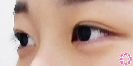 年代：10代 施術名：二重埋没法 施術後｜【公式】東京形成美容外科