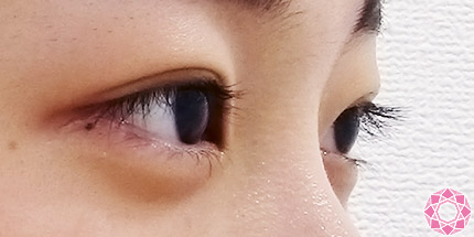 年代：10代 施術名：二重埋没法 施術後｜【公式】東京形成美容外科