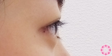 年代：10代 施術名：二重埋没法 施術後｜【公式】東京形成美容外科