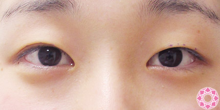 年代：10代 施術名：二重埋没法 施術前｜【公式】東京形成美容外科