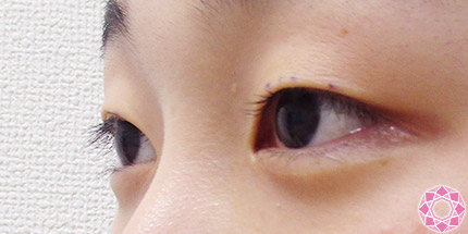 年代：10代 施術名：二重埋没法 施術前｜【公式】東京形成美容外科