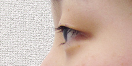 年代：10代 施術名：二重埋没法 施術前｜【公式】東京形成美容外科