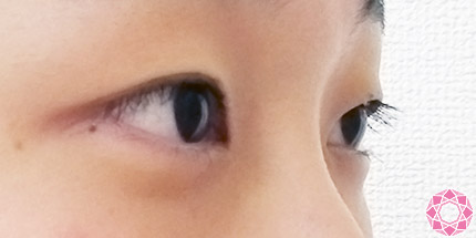 年代：10代 施術名：二重埋没法 施術前｜【公式】東京形成美容外科