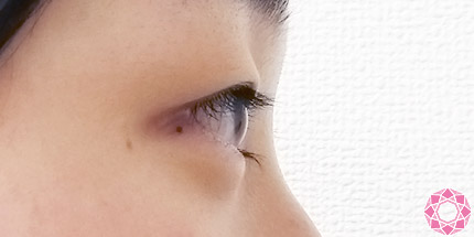 年代：10代 施術名：二重埋没法 施術前｜【公式】東京形成美容外科