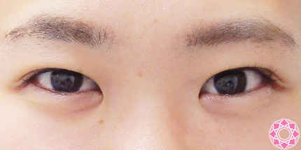 年代：10代 施術名：二重埋没法 施術後｜【公式】東京形成美容外科