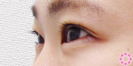 年代：10代 施術名：二重埋没法 施術後｜【公式】東京形成美容外科