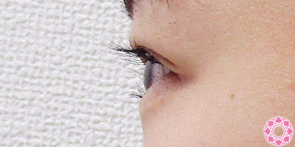 年代：10代 施術名：二重埋没法 施術後｜【公式】東京形成美容外科