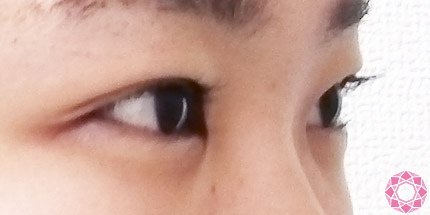 年代：10代 施術名：二重埋没法 施術後｜【公式】東京形成美容外科