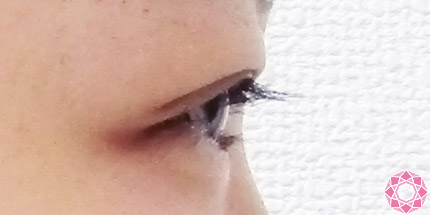 年代：10代 施術名：二重埋没法 施術後｜【公式】東京形成美容外科