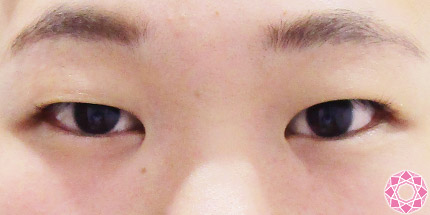 年代：10代 施術名：二重埋没法 施術前｜【公式】東京形成美容外科