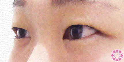 年代：10代 施術名：二重埋没法 施術前｜【公式】東京形成美容外科